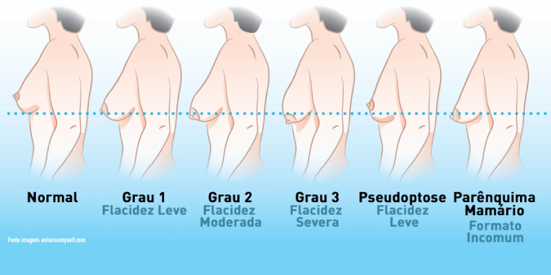 protese-mamas-clinica-renova