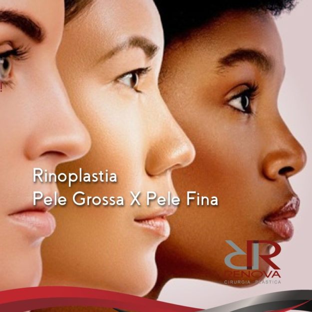 rinoplastia-renova-df rinoplastia