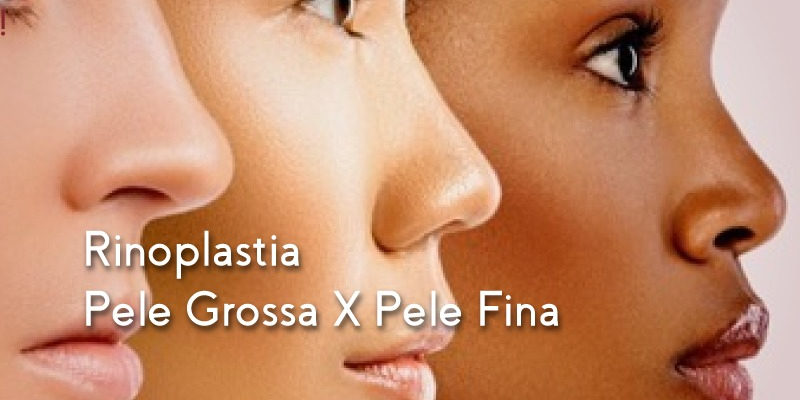 rinoplastia