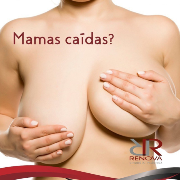 mamas-caidas-seios-mastopexia mastopexia clínica renova df