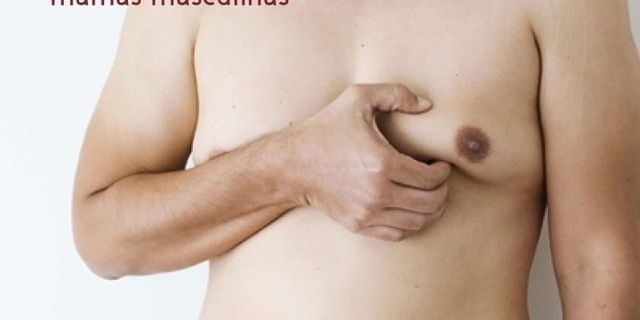 Ginecomastia-clinica-renovaa-df Ginecomastia Mams Homem Clínica Renova DF