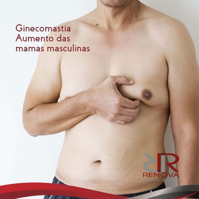Ginecomastia Mams Homem Clínica Renova DF