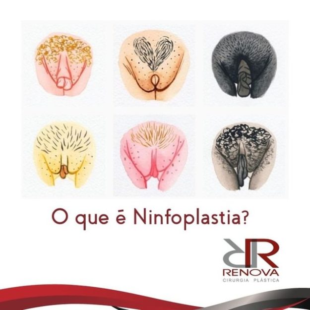 Ninfoplastia Clínica Renova DF