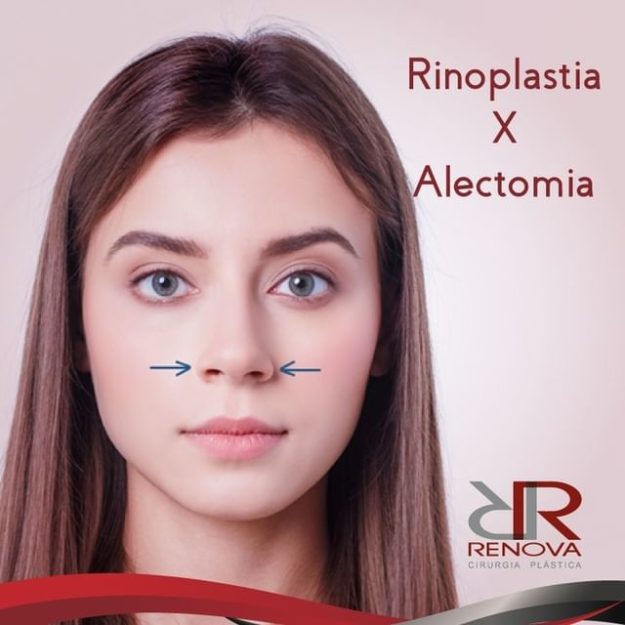Rinoplastia x alectomia Clínica Renova DF