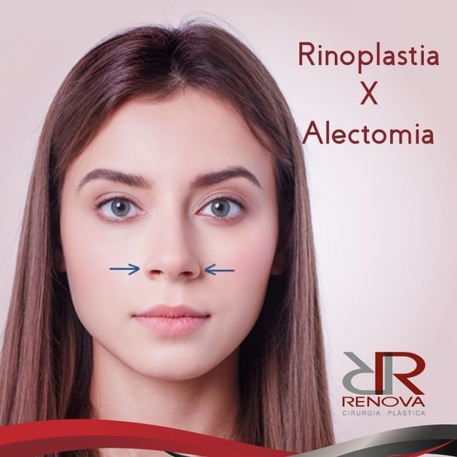 Rinoplastia x alectomia Clínica Renova DF