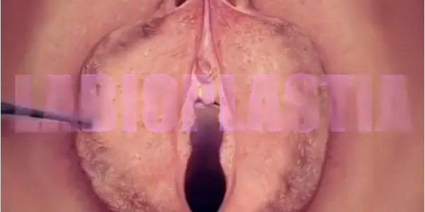 labioplastia-site-renova-df Labioplastia Cirurgia Íntima Feminina