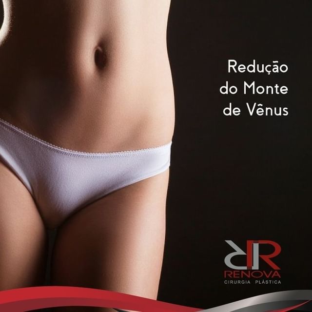 Lipoaspiração Monte de Vênus Clínica Renova