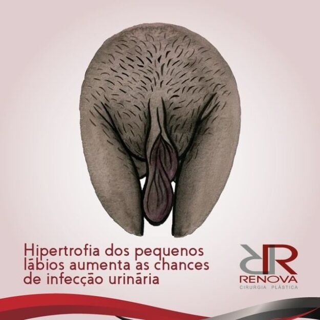 pequenos lábios hipertrofia sua clinica renova df